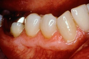 After Pinhole Surgical Technique