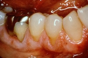 Before Pinhole Surgical Technique