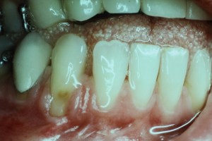 Gum Recession Grafting