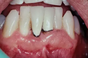 Gum Recession Grafting