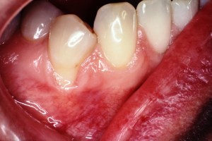 Gum Recession Grafting