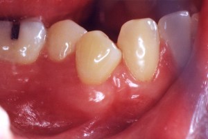 Gum Recession Grafting