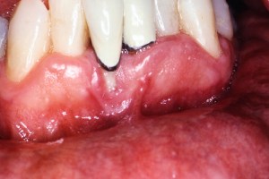 Gum Recession Grafting