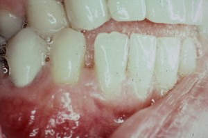 Gum Recession Grafting