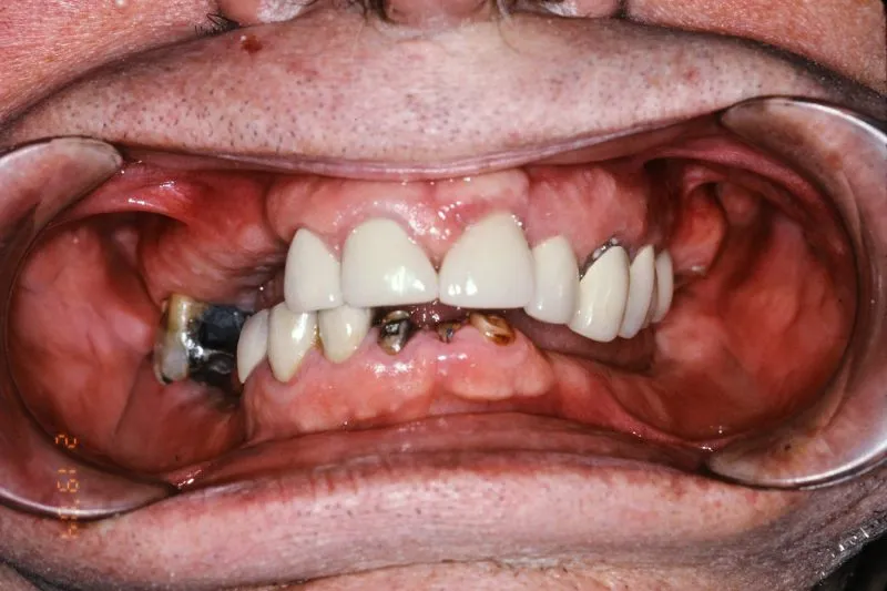 Before Dental Implants