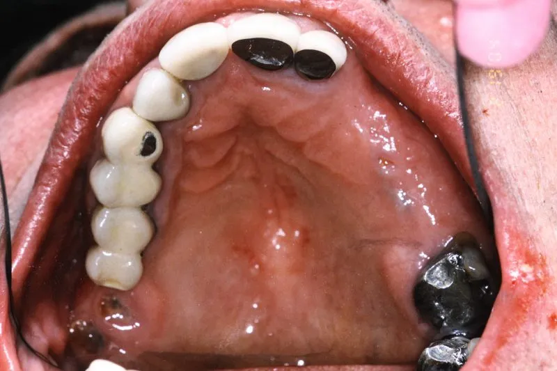 Before Dental Implants