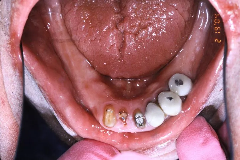 Before Dental Implants