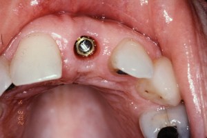 Dental Implants