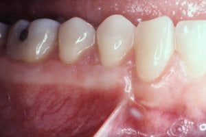 Pinhole Surgical Technique
