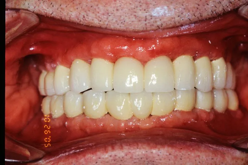 After Dental Implants
