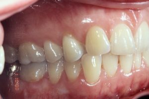 Gum Recession Grafting