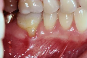 Gum Recession Grafting