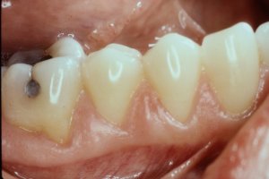 Pinhole Surgical Technique
