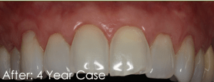 After Pinhole Surgical Technique