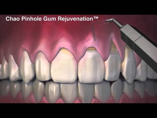 Root Canal Treatment Step by Step
